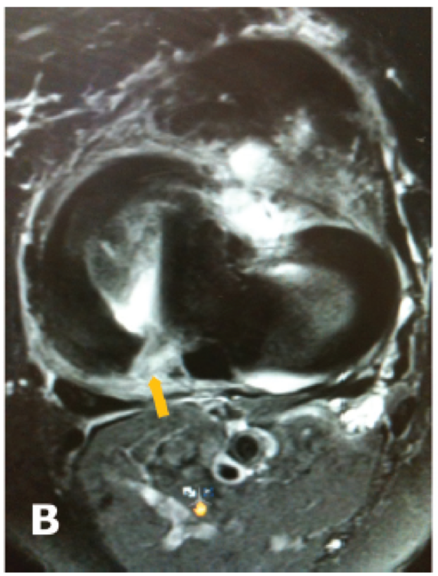 MRI Meniscal Root tear
